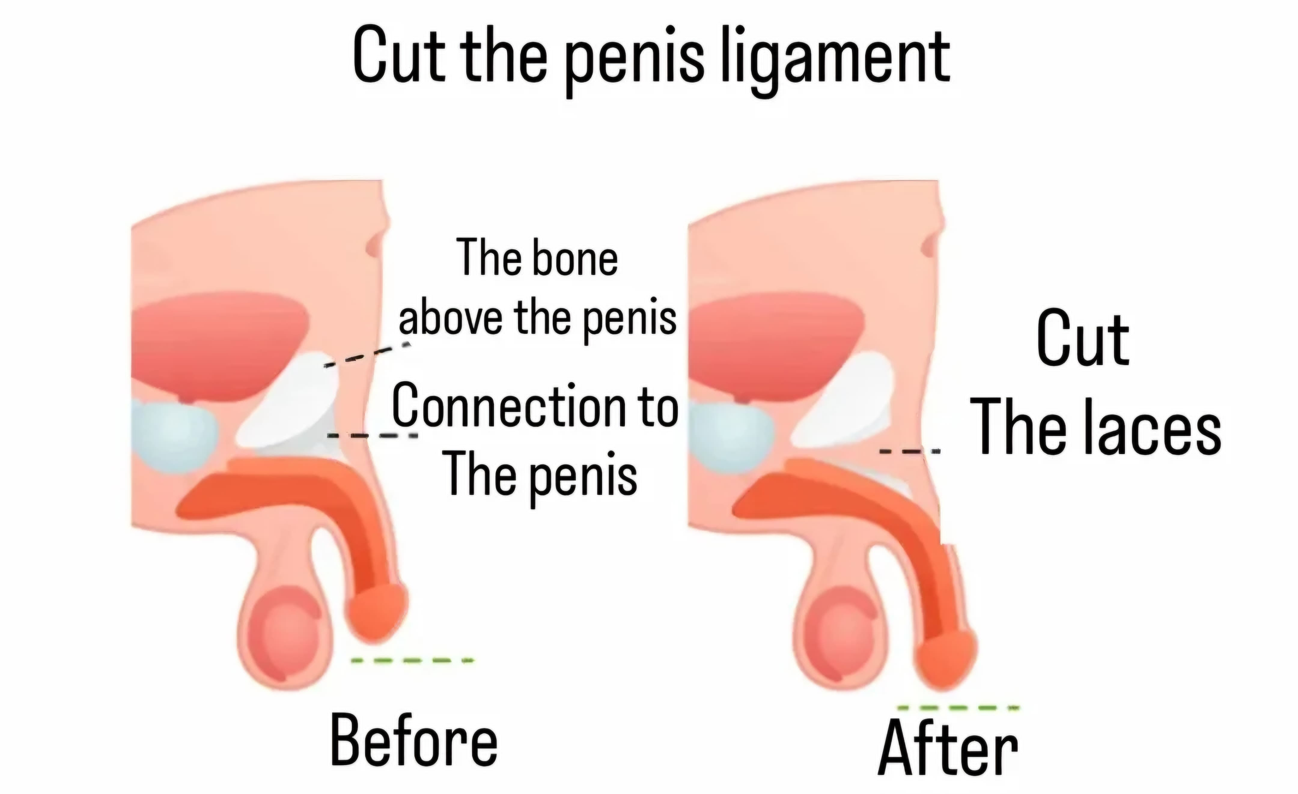 Penile Lengthening Surgery